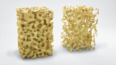 صورة اليوم العالمي لهشاشة العظام.. كل ما تريد معرفته عن المرض وطرق العلاج